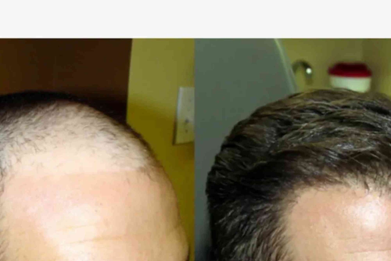 Best Hair Transplat Turkey